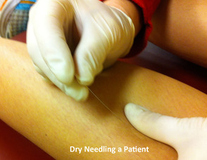 Dry Needling