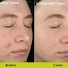 Small_thumb_878bc02f65ffcfc976ab_clenziderm_beforeafter_digitalframer1-2