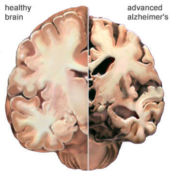574fe8606b6636ddbb39_alzheimer_brain.jpg