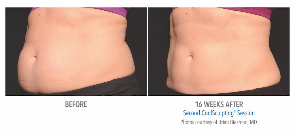887dd2a0e4b812182fcc_211-Female-Abdomen-DrBiesman-Medium-1.jpg