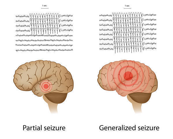 af2c2aa25446c8f58dbd_8ab5636be5e27f14dce3_EpilespyImage.jpg