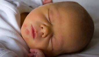 f8b3219429b3d22f5c7d_bc9d40a6aeb4b848f245_newborn-jaundice_342x198_C43BW3.jpg